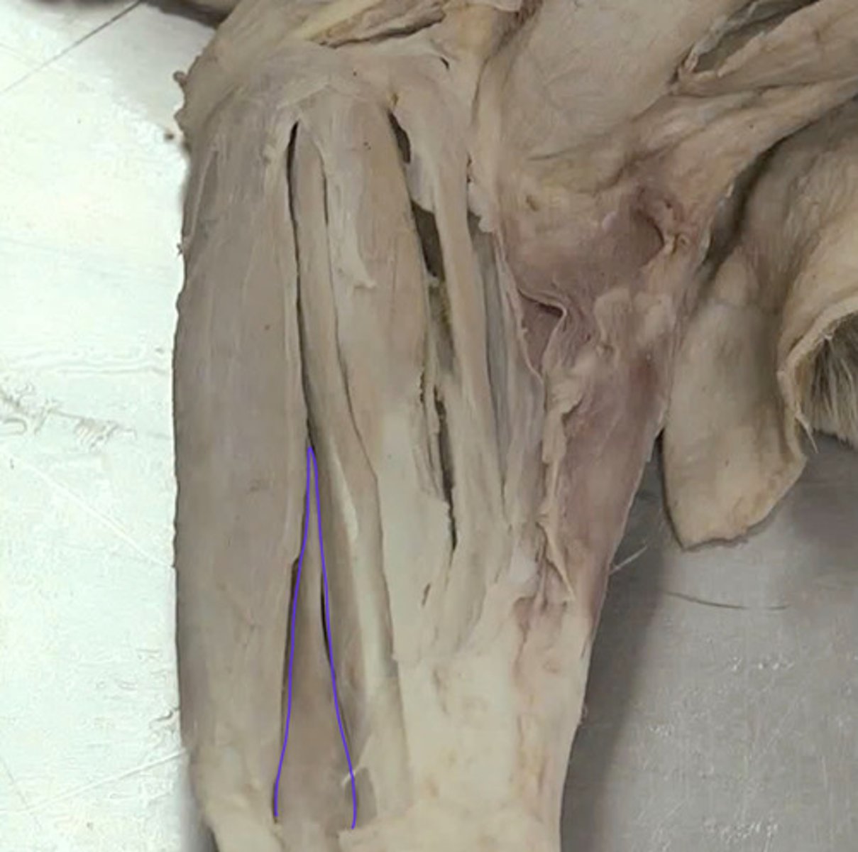 <p>Origen: epicóndilo md húmero (cabeza humeral) y olécranón (cabeza cubital).</p><p>Inserción: huesos accesorio carpo. Retináculo de los flexores</p><p>Función: flexor carpo</p><p>Inervación: N. cubital y mediano</p>