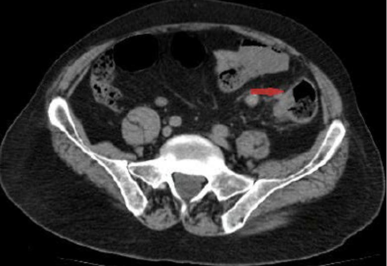 <p><em>CT Abdomen/Pelvis IV contrast</em></p>