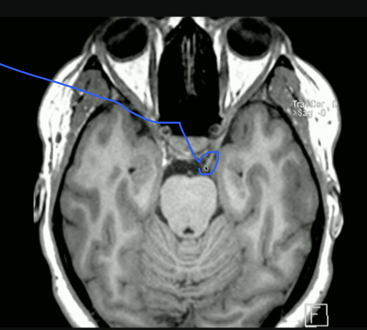 <p>What nerve travels here?</p>
