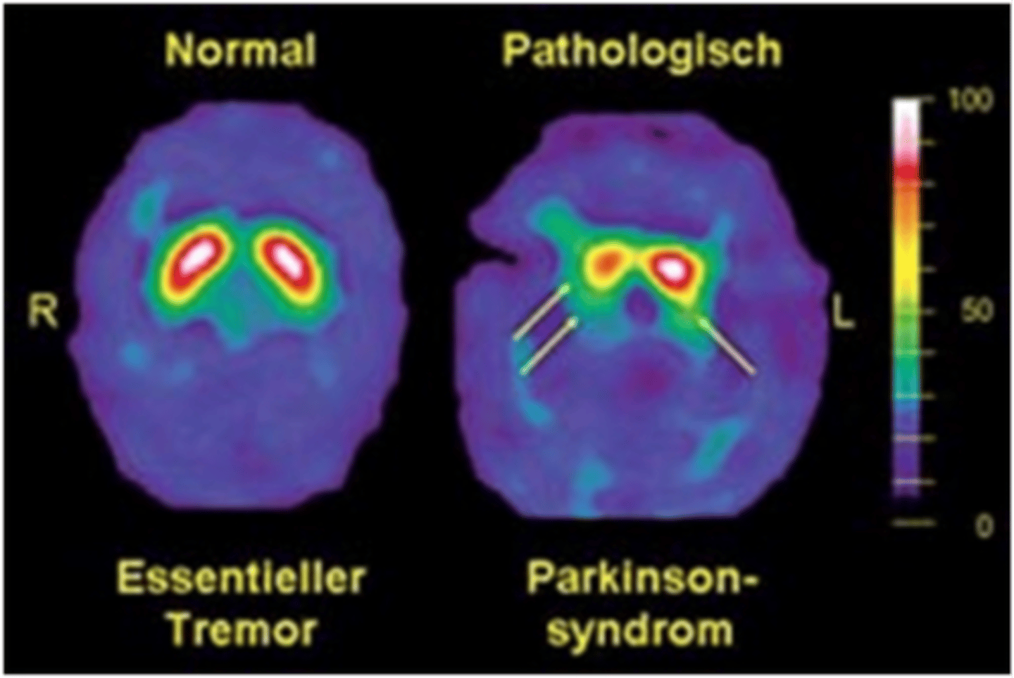 <p>Nuclear scans that can help diagnose cases of uncertain parkinsonism (usually only used in big research centers)</p>