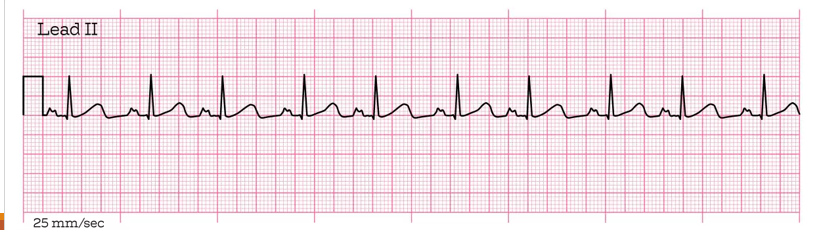 <p>What kind of heart problem is this + how to spot it?</p>