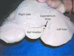 <p>Remnant of the obliterated umbilical vein that runs along the free edge of the falciform ligament in adults</p><p>ROUND LIGAMENT OF LIVER, hanging off</p>