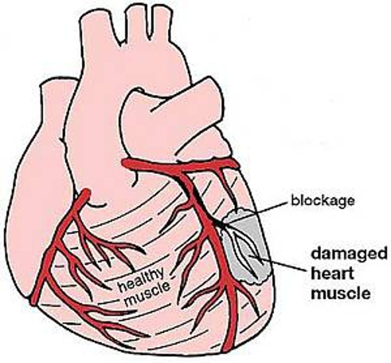 <p>A reduction in the supply of blood to the heart resulting in damage to the mucked of the heart.</p>