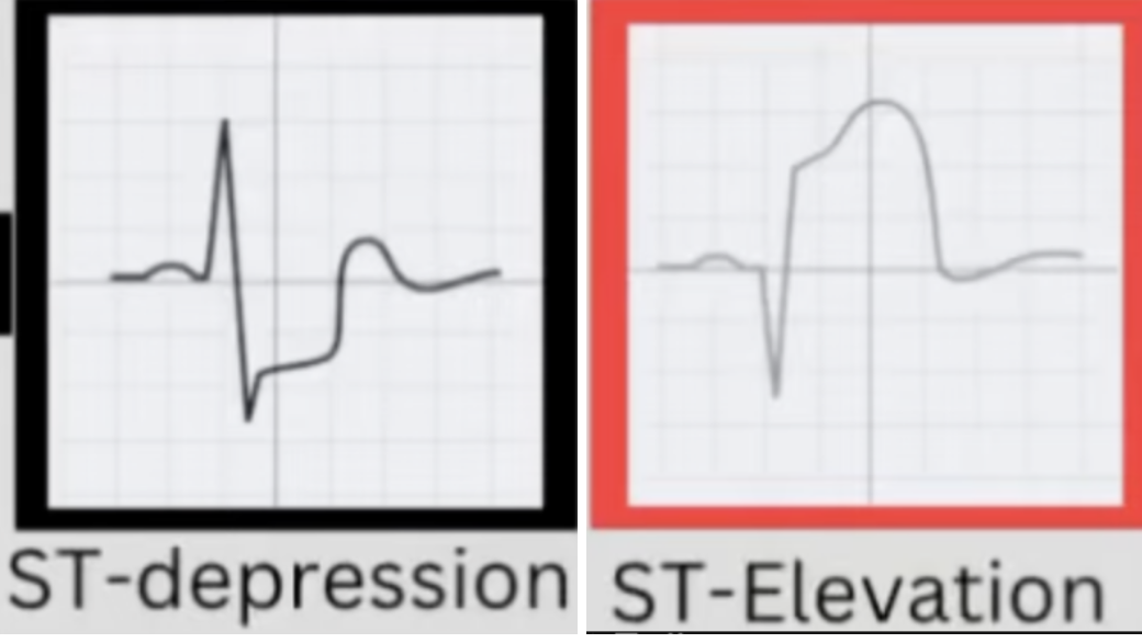 <p>NSTEMI VS STEMI</p>