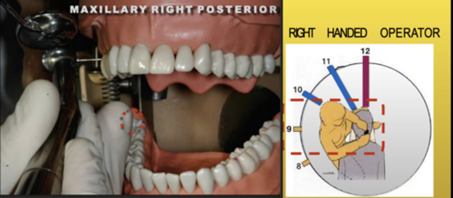 <p>Zone: 9</p><p>Vision: Direct</p><p>Patient's Head: Left</p><p>Fulcrum: Mand Right Posteriors (B)</p>