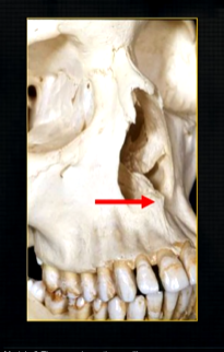 <p>bony spike of the anterior nasal spine </p>