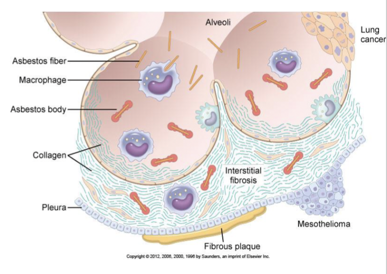 <p>Associated with:</p><ul><li><p>pulmonary fibrosis</p></li><li><p>pleural fibrosis and pleural plaques</p></li><li><p>lung cancer</p></li><li><p>malignant mesothelioma</p></li></ul><p>Pathology:</p><p>-asbestos bodies</p><p>Clincial: </p><ul><li><p>restrictive lung disease</p></li><li><p>risk of cancer</p></li></ul><p></p>