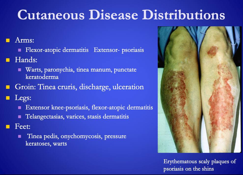 <p><strong><u>Cutaneous Disease Distribution &nbsp;</u></strong></p><ul><li><p><span><strong>[Where are these usually found?]</strong></span></p><ul><li><p>Tinea pedis</p></li><li><p>onychomycosis</p></li><li><p>pressure keratoses</p></li><li><p>warts&nbsp;</p></li></ul></li></ul><p></p>