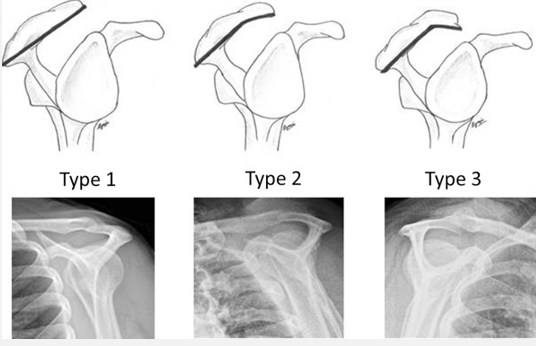 <p>Shoulder Impingement has Anatomical Contributors such as changes in shape of</p>