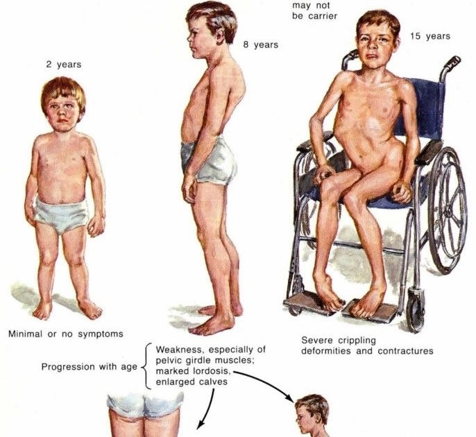 <p>Muscular dystrophy is a group of <strong>inherited (genetic) diseases that cause the gradual wasting of muscles overtime. </strong></p><ul><li><p>Not the same as 渐冻症 which is a type of neurodegenerative disease that affects motor neurons (even though both cause immobility) </p></li></ul><p></p>