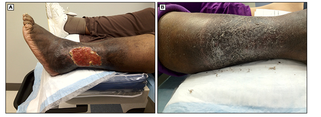 <ul><li><p>brownish pigment</p></li><li><p>pitting edema</p></li><li><p>skin thickening</p></li><li><p>malleolar ulcers</p></li><li><p>normal pulses</p></li><li><p>no pain</p></li></ul><p></p>