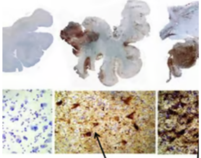 <p>The brain slides above with neurofibrillary tangles from what condition?</p><p>A- alzheimer </p><p>B- parkinsons </p><p>C- stroke </p><p>D- CTE </p><p>E- TIA</p>