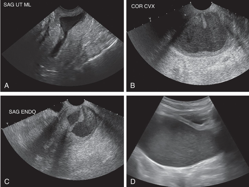 <p>• Cervical stenosis is acquired condition.</p><p class="p1">• Obstruction of cervical canal at internal or external os resulting</p><p class="p1">from</p><p class="p1">• Radiation therapy</p><p class="p1">• Previous cone biopsy</p><p class="p1">• Postmenopausal cervical atrophy</p><p class="p1">• Chronic infection</p><p class="p1">• Laser or cryosurgery</p><p class="p1">• Cervical carcinoma</p><p class="p1">• Menopausal patient may be asymptomatic even though <em>stenosis</em></p><p class="p1"><em>can produce a distended, fluid-filled uterus</em> (the result of an</p><p class="p1">accumulation of uterine secretions, fluid hydrometra, pyometra,</p><p class="p1">or hematometra).</p><p class="p1">• Intracavitary fluid collections can be readily seen on ultrasound</p><p class="p1">and may be indirect indicator of cervical stenosis.</p><p class="p1">• Premenopausal patients may experience abnormal bleeding,</p><p class="p1">oligomenorrhea, amenorrhea, cramping, dysmenorrhea, or</p><p class="p1">infertility.</p>