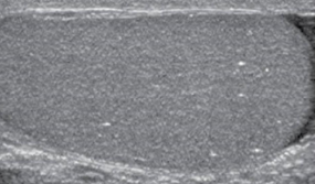 <p>microlithiasis</p>