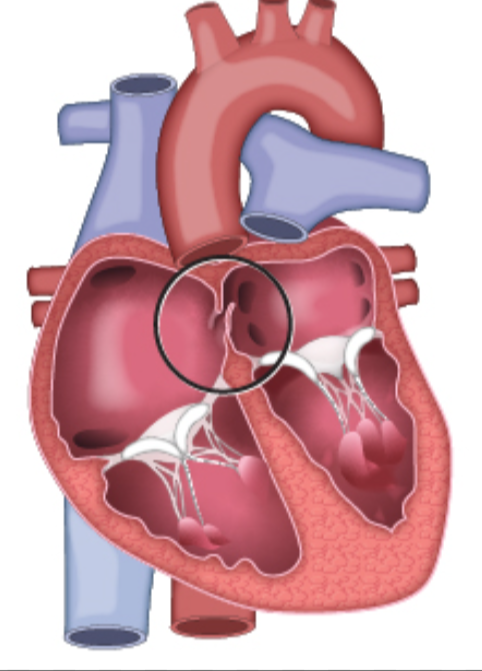 <p>Identify this birth “defect” and what does it turn into </p>