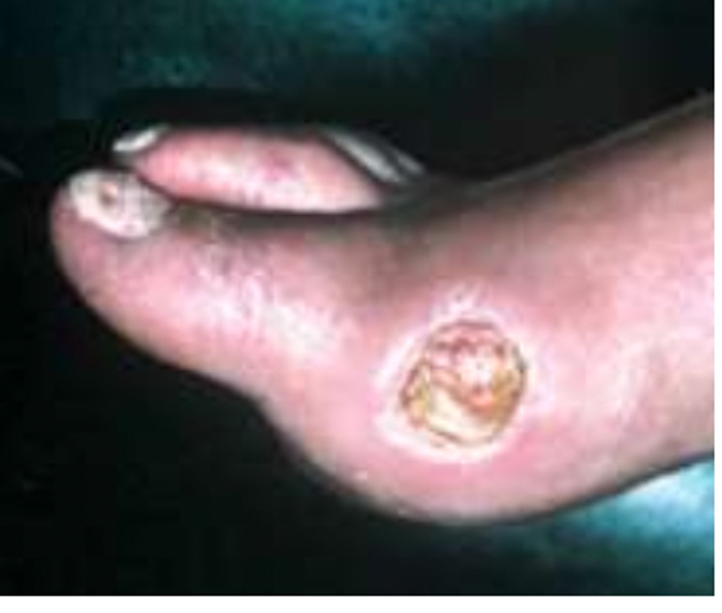 <p>Arterial wounds occur most often on the foot, in between or at the tips of the toes, at pressure points from foot wear, on the heels and around the lateral malleolus (the bone on the outside of the ankle joint).</p>