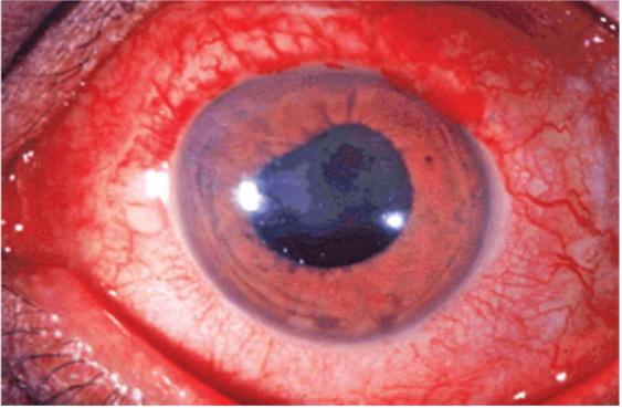 <ul><li><p>inflammation in deeper structures such as iris or ciliary body (uveitis) </p></li><li><p>perforating anterior ciliary arteries that supply major arterial circle of iris become congested and show injection of perilimbal vascular plexus</p></li><li><p>peripheral bulbar conj not injected as perilimbal region</p></li></ul><p></p>