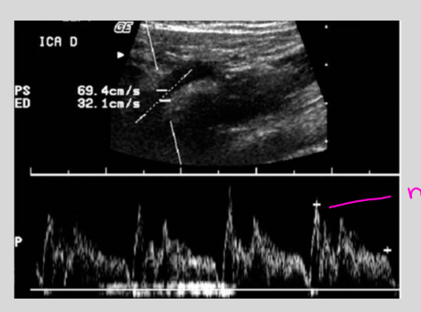 <p>Aortic Insufficiency</p>