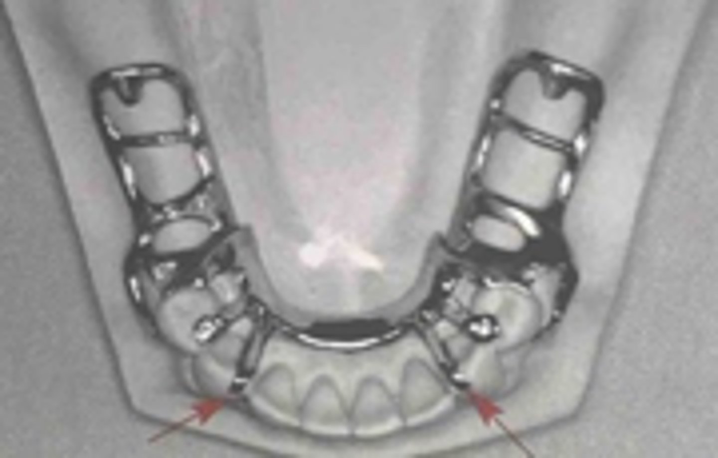 <p>Indirect retainer type when premolars are unavailable or inappropriate)</p><p>• Cingulum rest on maxillary canines</p><p>• Incisal or cingulum rest on mandibular canines</p>