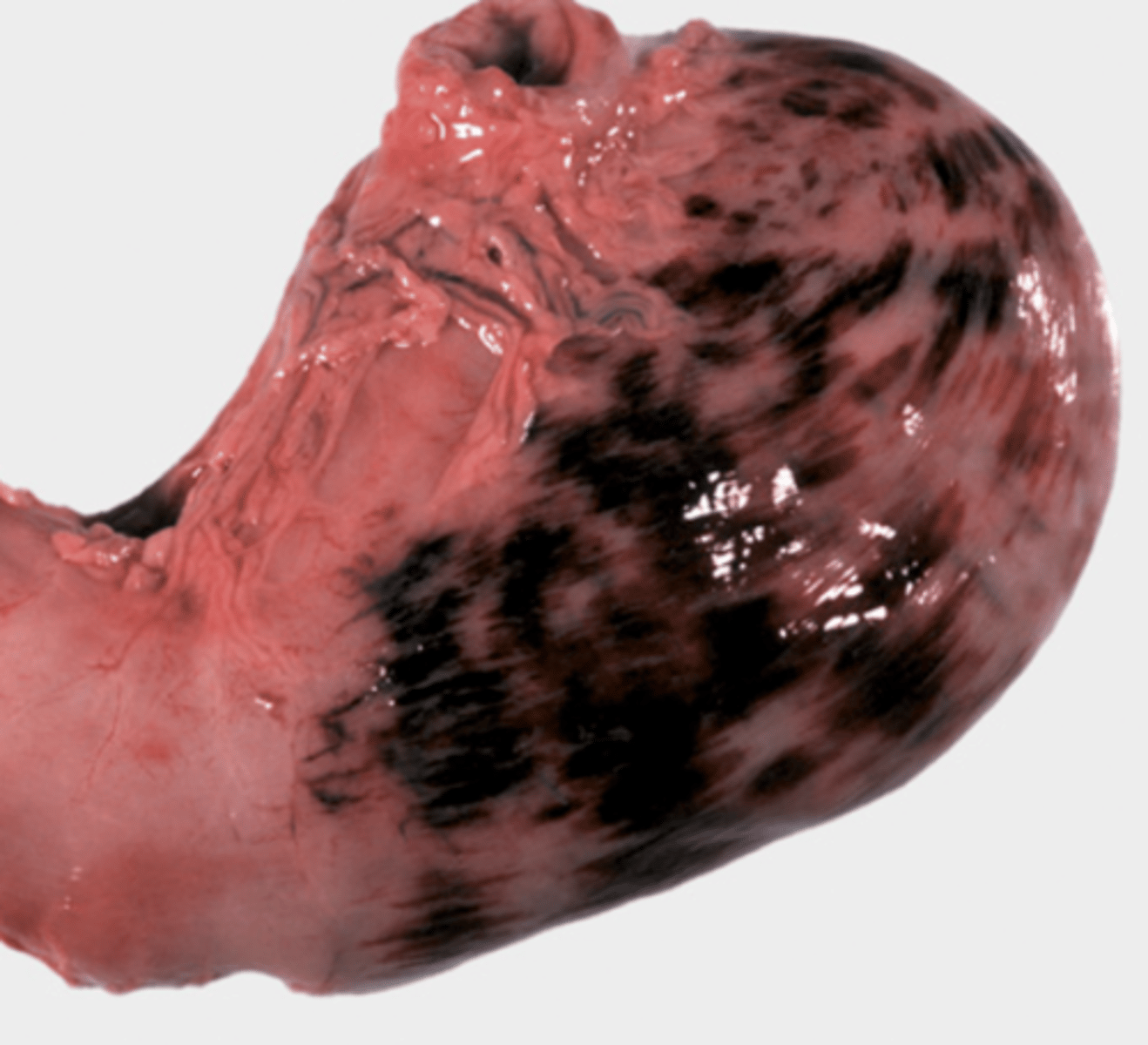 <p>What type of hemorrhages are being shown?</p>