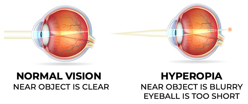 how do people with hyperopia see?
