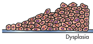 <p>Abnormal growth or development of cells, often leading to tissue architecture changes. </p>