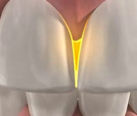 <p>The area between adjacent tooth surfaces</p>