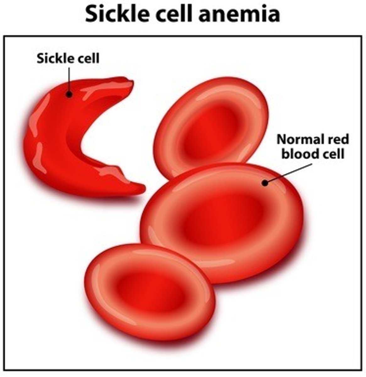 <p>Condition where not enough healthy red blood cells to carry 'O' throughout body; red blood calls have abnormal shapes + textures - normally uniform + cup-shaped</p><p>- accumulation can damage spleen - making pts vulnerable to infections</p>
