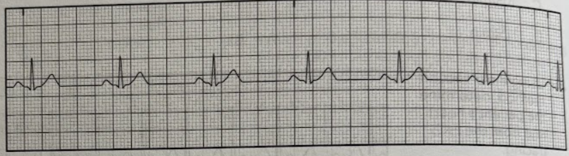 <p>Using the EKG tracing, determine the QRS duration.</p><p>A. 0.04 sec</p><p>B. 0.06 sec</p><p>C. 0.12 sec</p><p>D. 0.2 sec</p>