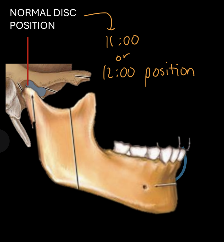 <p>Posterior border-11-12:00 position on condyle</p><p>Anterior prominence of condyle: central thin part of disc</p><p>Disc follows condyle during opening</p>