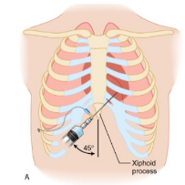 <p>Pericardiocentesis - US guided needle enters the chest wall and punctures the pericardium to extract the blood gathered there.</p>