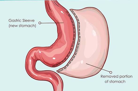 <p>why does sleeve gastrectomy lead to weight loss?</p>