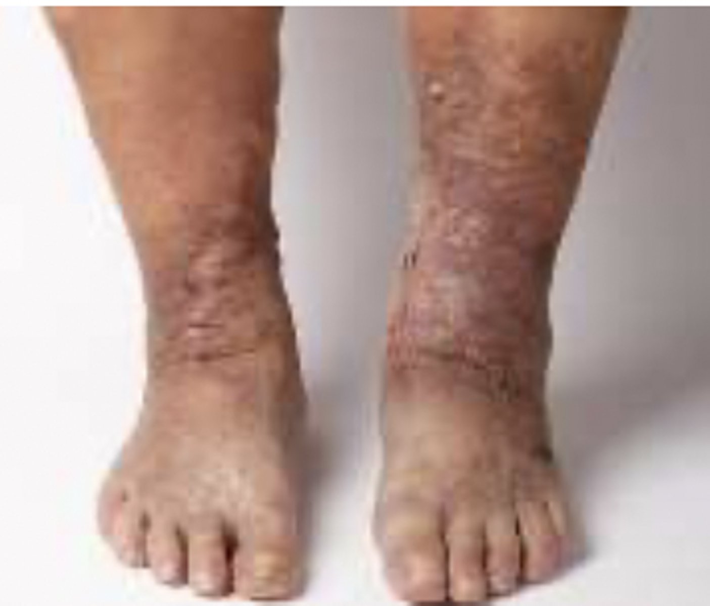 <p>Venous leg ulcers usually develop on the inner lower leg, above the medial malleolus.</p>