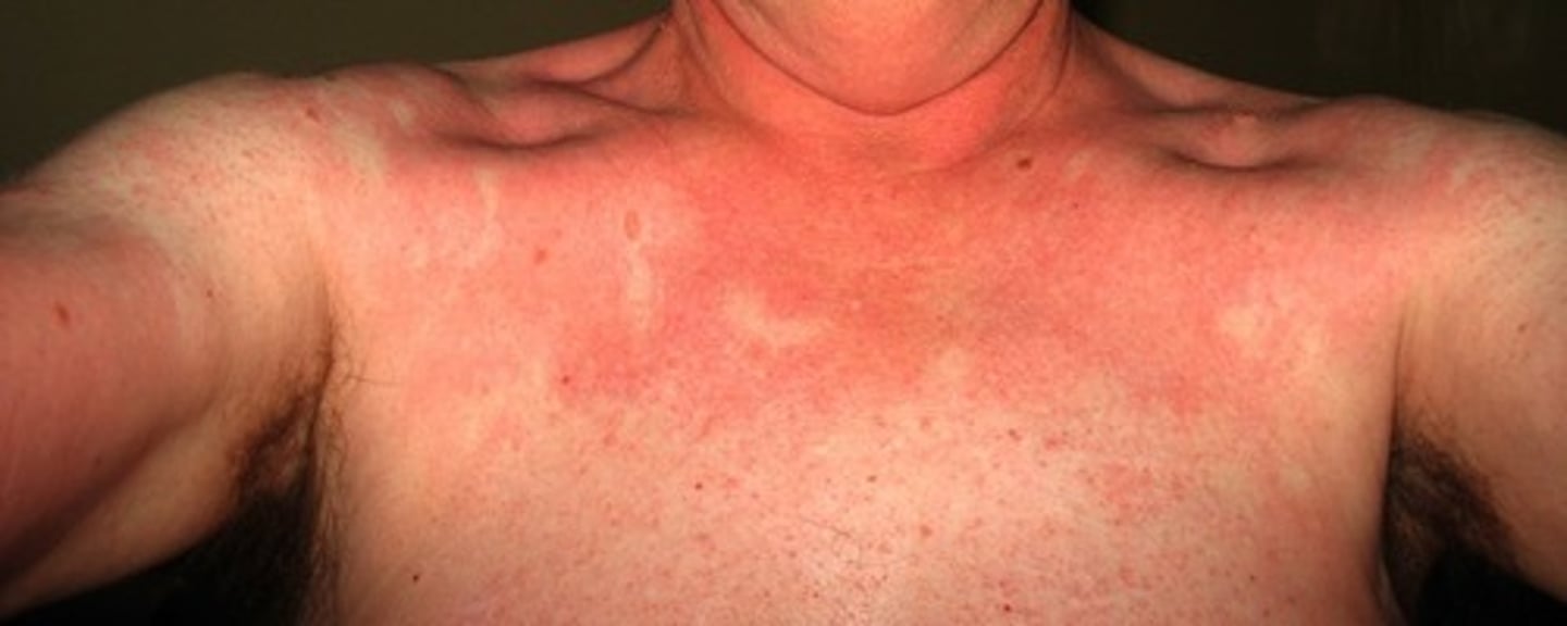 <p>diagnose this:</p><p>severe sunburn with minimal sun exposure</p>