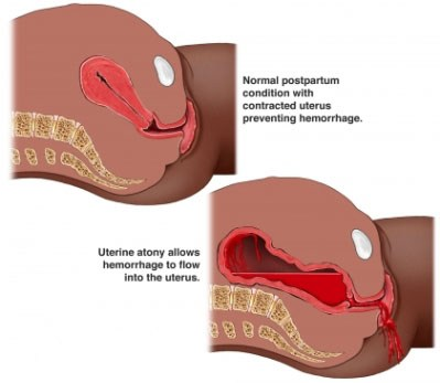 <p>inability if the uterine muscle to contract adequetly after birth, can lead to postpartum hemorrhage </p>