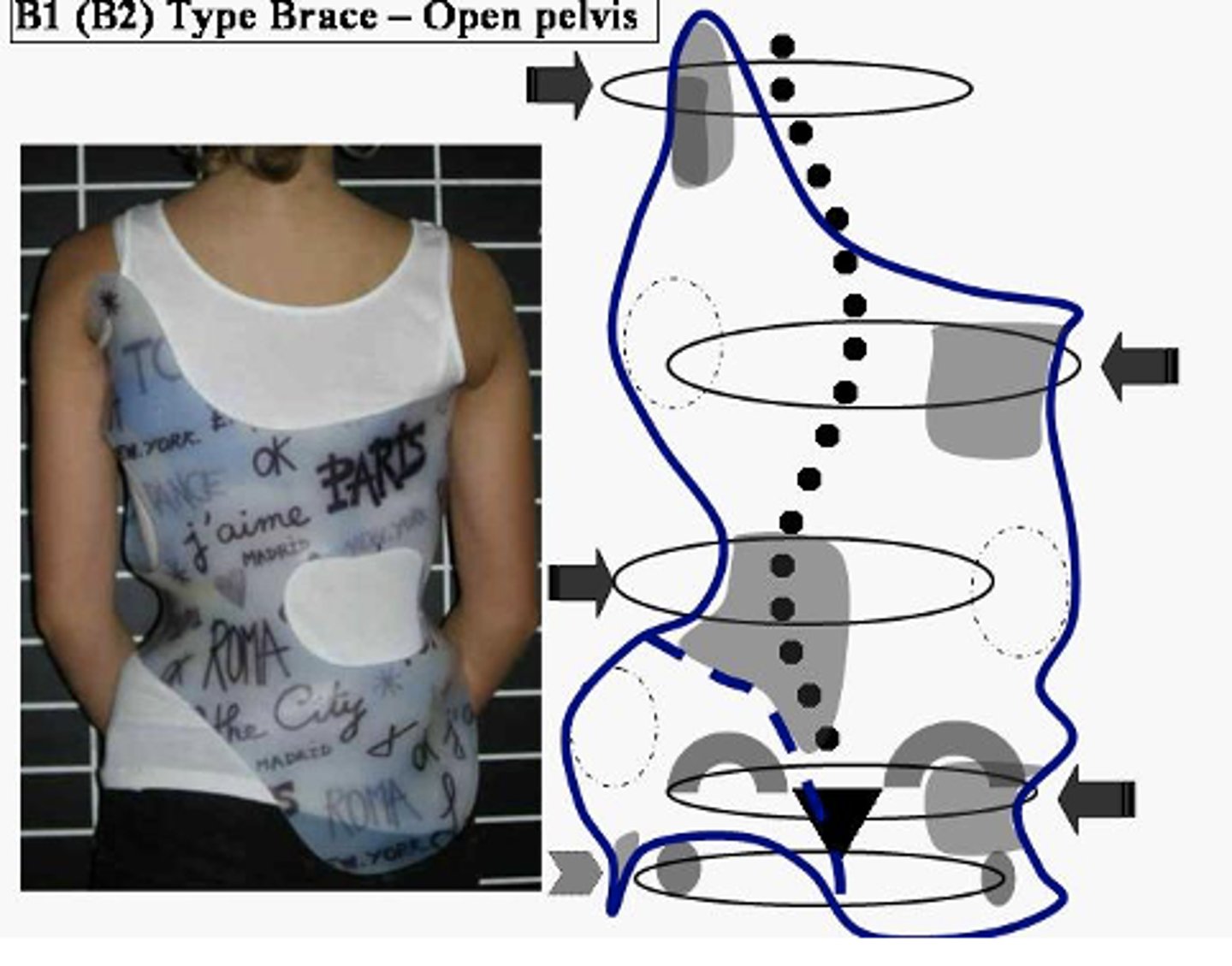 <p>in conjunction with exercises can correct lateral and rotational curves</p>
