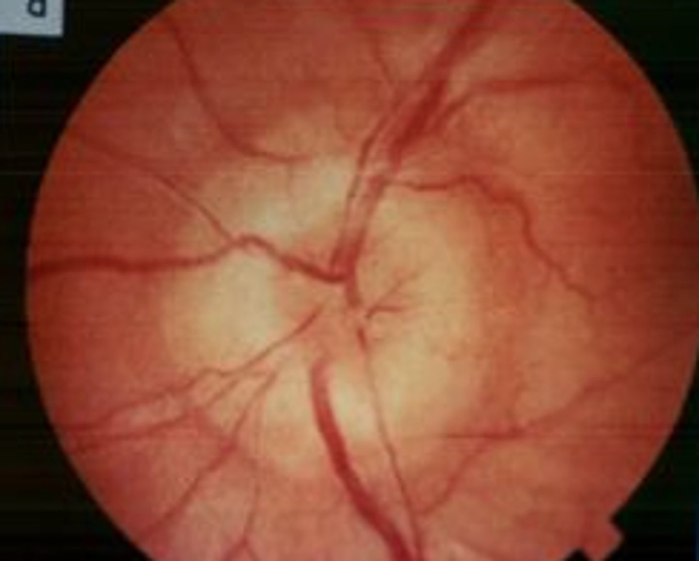<p><span><u>Etio:</u></span> <strong>disc swelling, due to severe HTN, increased intracranial pressure</strong>, usually bilaterally</p><p><span><u>S&amp;S</u></span>: headache, nausea, vomiting, ± vision changes</p><p><span><u>Complications</u></span>: vision loss</p><p><u>Testing</u>: <strong>fundoscopic exam</strong></p><p><span><u>Tx</u></span>: admit to hospital, control causation, control BP</p>