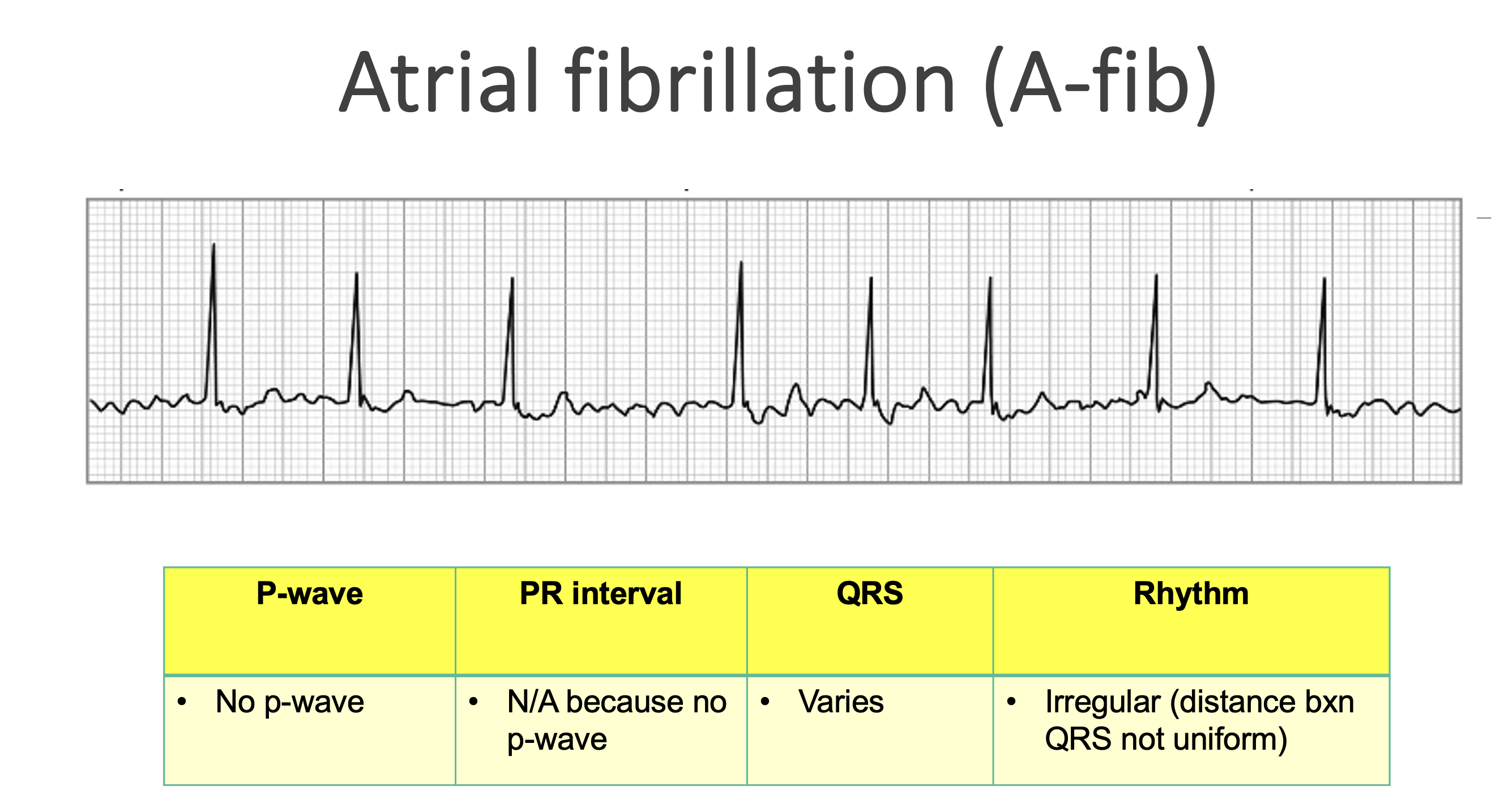 <p>Atrial fibrillation (A-fib)</p>