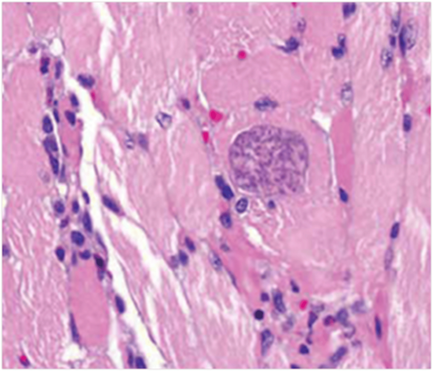 <p>This image shows histopathology on the tongue skeletal muscle. What lesion is seen here?</p>