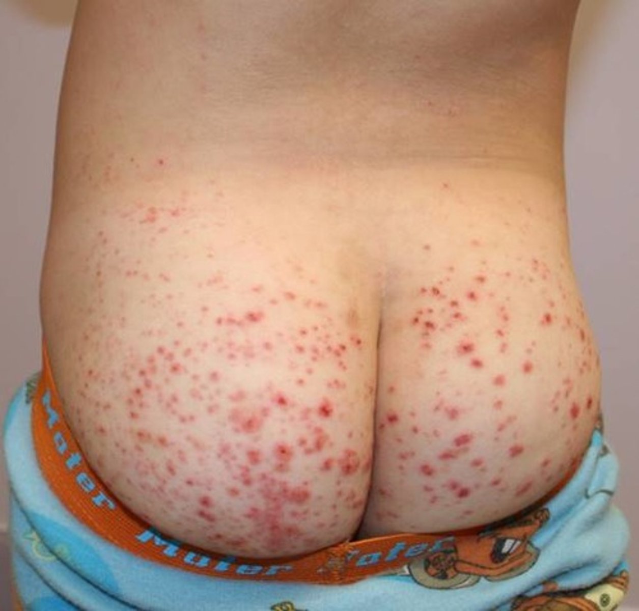 <p>Small vessel vasculitis of unknown cause characterized by arthralgia, non-blanching red-violet purpura (esp. on buttock), &amp; prominent abdominal pain; also can have fever, HA, &amp; nausea prodrome</p>