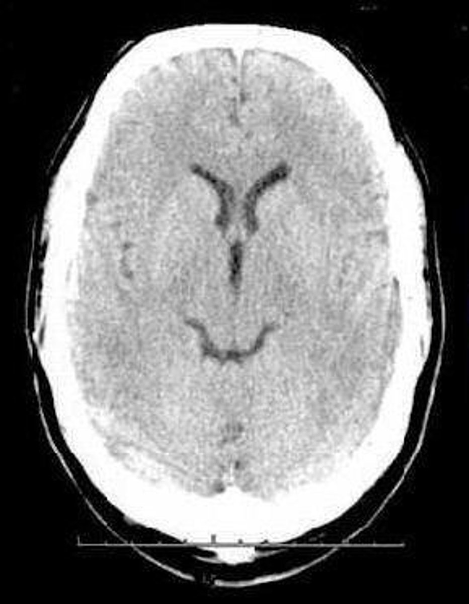 <p>Blood accumulation between skull and dura mater.</p>