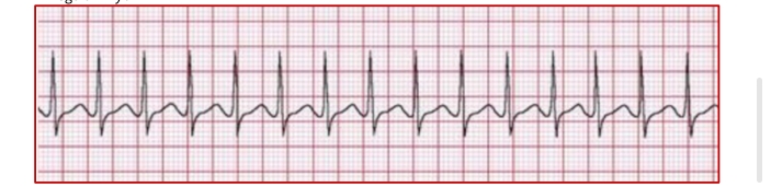 <p>Supraventricular Tachycardia</p>