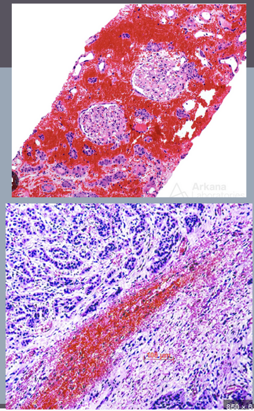 <p>iron storage molecule, partly derived from breakdown of RBCs</p><ul><li><p>usually found in macrophages</p><ul><li><p>especially in spleen +/- bone marrow</p></li></ul></li><li><p>seen in any tissue after hemorrhage</p></li><li><p>appearance depends on stain</p><ul><li><p>fixed H&amp;E stain: yellow-brown chunky pigment</p></li><li><p>cytology smear Wright stain: blue-green</p></li><li><p><strong>Prussian blue stain</strong> can be used to <strong>stain the iron turquoise</strong></p></li></ul></li></ul><p></p>