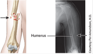 <p>The bone is splintered, crushed, or broken into pieces at the site of impact, and smaller bone fragments lie between the two main fragments.</p>