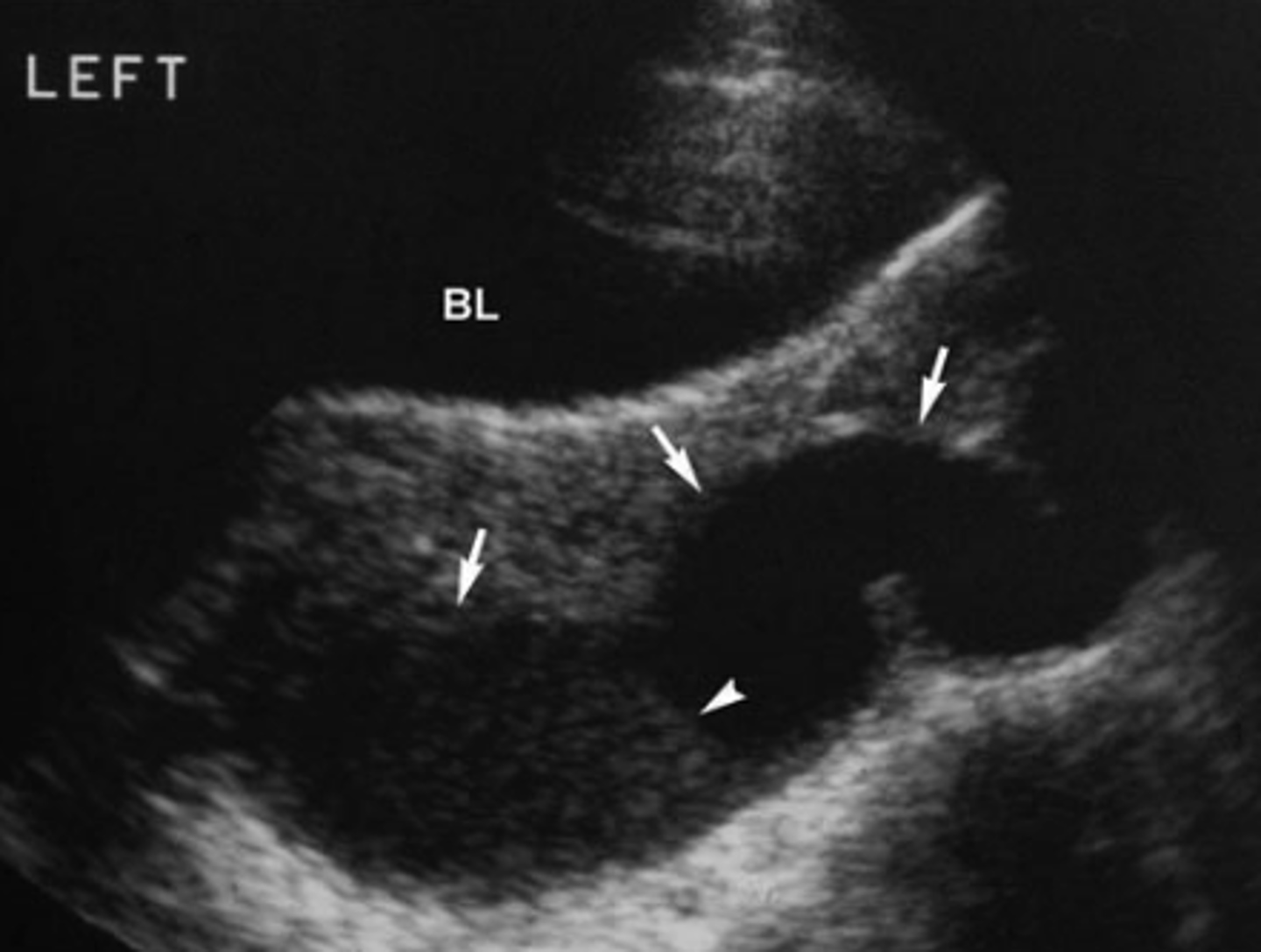 <p>Elevated WBC, fever, pain, may have internal echoes</p>