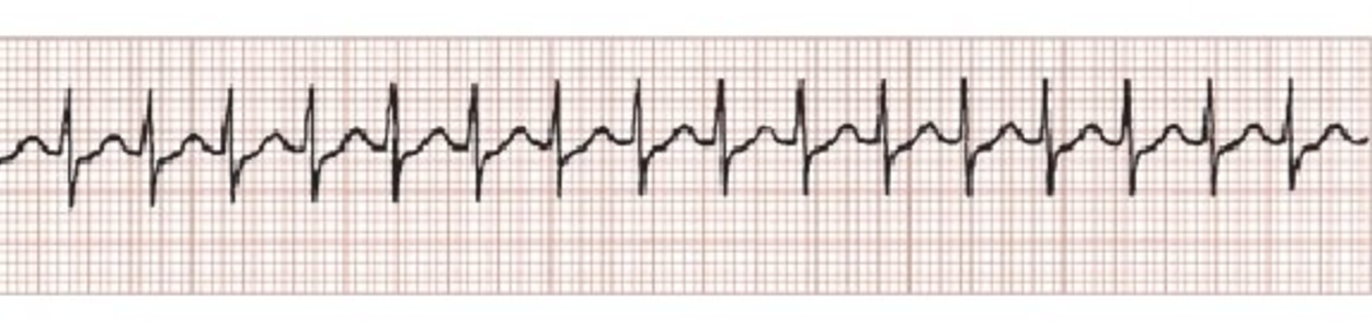 <p>HR:150-250 bpm</p><p>P-wave: absent</p><p>Regularity:Regular</p><p>PR Interval: shorten</p><p>QRS Duration: Normal</p><p></p>