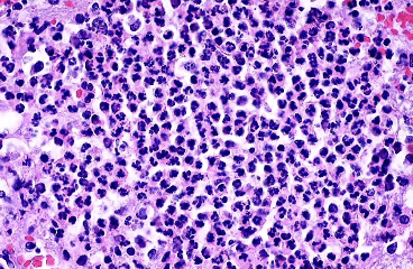 <p>What type of necrosis is being shown in this photo?</p>