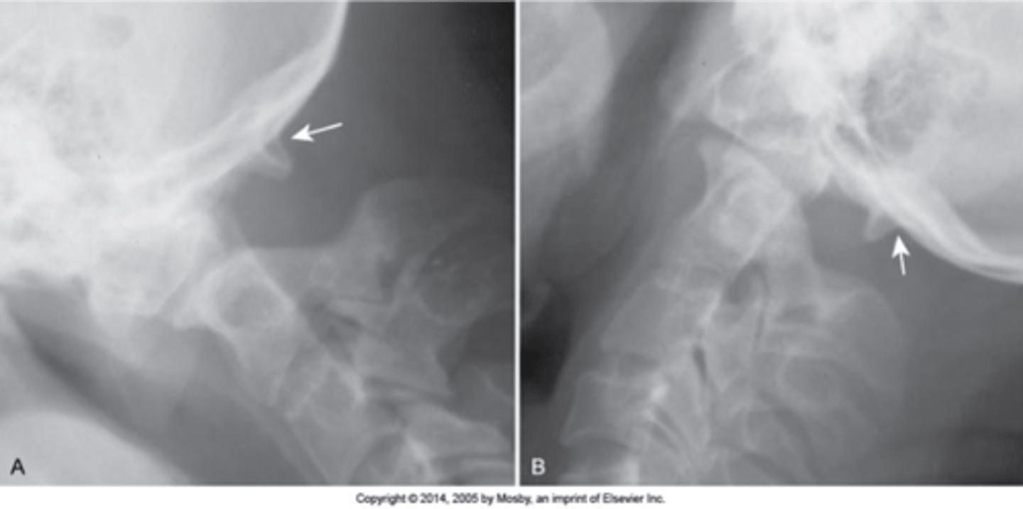 <p>Occipitalization is associated with _____ ROM, can have short neck/low hairline</p>