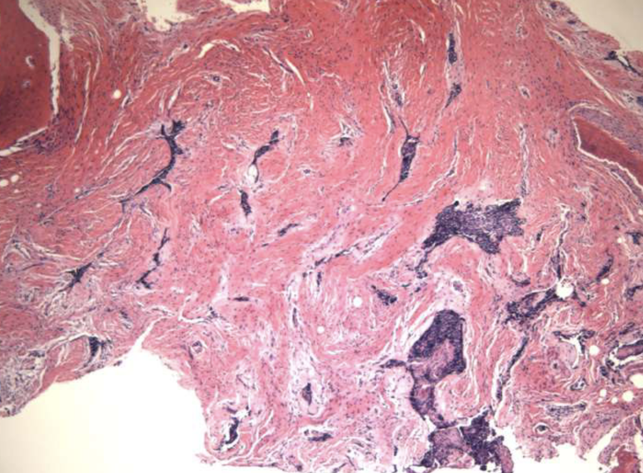 <p>compressed islands + cords of odontogenic epithelium in densely collagenized stroma, presents in anterior max </p>