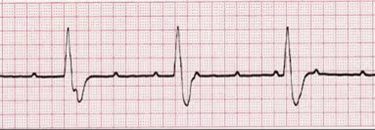 <p>Which Arrythmia is this?</p>